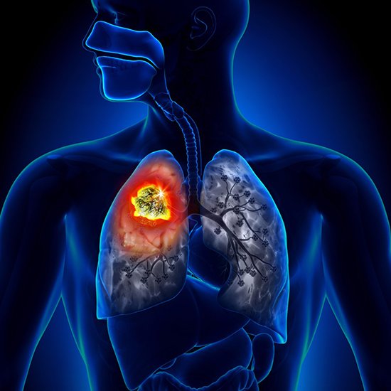 ВООЗ закликає розширити доступ до швидких молекулярних тестів для виявлення туберкульозу