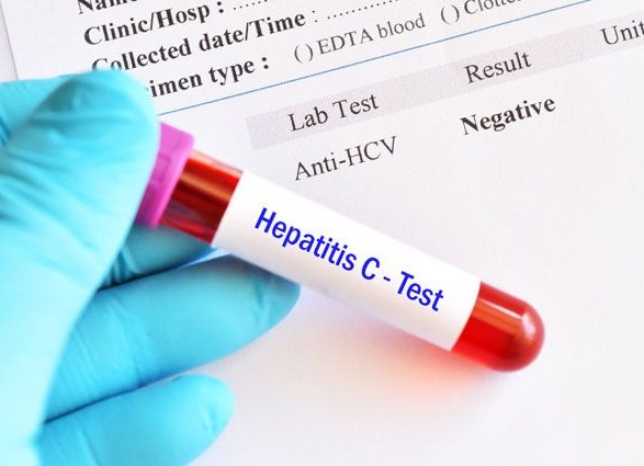 Діагностика вірусного гепатиту С